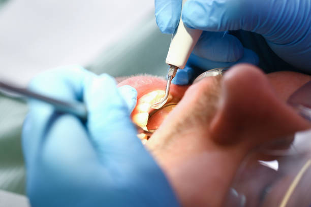 Best Root Canal Emergency Dentist  in Butte, AK