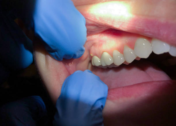 Tooth Infection Emergency Dentist in AK